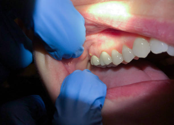 Best Emergency Treatment for Dental Infections or Abscesses in Lake Caroline, VA